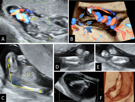 Body-stalk anomaly features. (A) Short umbilical cord evidenced using directional power Doppler, accompanied by omphalocele (O). (B) 3D rendering of the umbilical cord, showing the placental insertion embedded in amniotic sheets, indicated with arrows. (C) Axial pelvic view showing fixed adduction deformity of the thighs with a wide angle between the femurs (F) and the protruding omphalocele (O). (D, E) Bilateral limb anomalies with fixed flexed legs and bilateral clubfoot with talipes eqinus and varus.