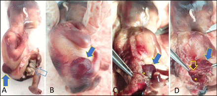 Spinal defect investigation at the pathology examination. (A) Abdominal wall defect with gut herniation (open arrow). (A, B) Lumbosacral bulging (solid arrow) covered with skin. (C, D) Large lumbosacral spinal defect (*) and the continuity of the myelomeningocele (solid arrow) with spinal cord (open arrow).