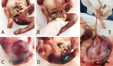 Features of body-stalk anomaly associated with omphalocele, exstrophy of the bladder, imperforate anus and sacral agenesis complex at the pathology examination. (A, B) Large ventral abdominal defect extended from the umbilical insertion region to the pubic symphysis. (C, D) Absent anus in the perineal area, suggesting imperforate anus. (E) Placenta and umbilical cord aspect, with short umbilical cord embedded in amniotic sheets.