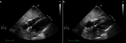 Echocardiography on day 4 after stabilisation and recovery showed normal RV size and systolic function, mild tricuspid regurgitation and normal LV function. RVSP=30 mm Hg, RV length=69 mm, RV basal dimension=31.6 mm, RV FAC=35%, TAPSE=19 mm, LV EF=55%. (A) Subcostal long-axis view during diastole. (B) Subcostal long-axis view during systole. EF, ejection fraction; FAC, fractional area change; LV, left ventricle; RV, right ventricle; RVSP, right ventricle systolic pressure; TAPSE, tricuspid annular plane systolic excursion.