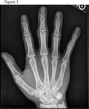 Initial X-ray of right hand. X-ray showed localised soft tissue swelling surrounding the aforementioned joints but an absence of any bony abnormalities.
