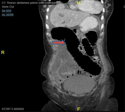 Coronal CT image suggestive of small bowel distension.