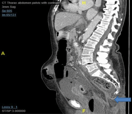 Sagittal CT image shows extension of bowel into pelvis with a perineal hernia.