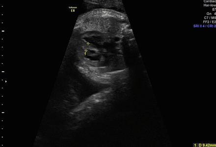 Prenatal ultrasound scan showing fetal myocardial hypertrophy with a thickened interventricular septum diameter of 9.42 mm (>95th centile for gestational age).