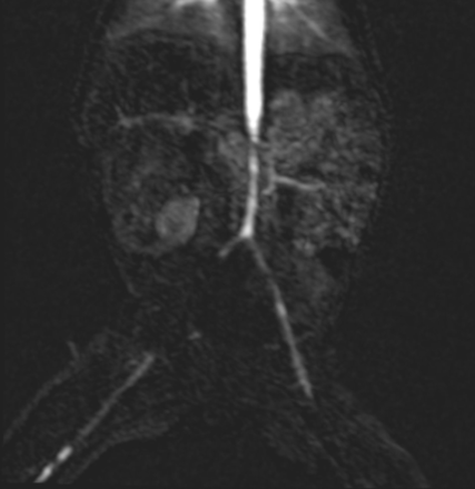 MR angiography showing several short- and long-segment stenoses in the area of the abdominal aorta with left side renal artery stenosis, stenosis of the superior mesenteric artery and stenosis of both iliac arteries.