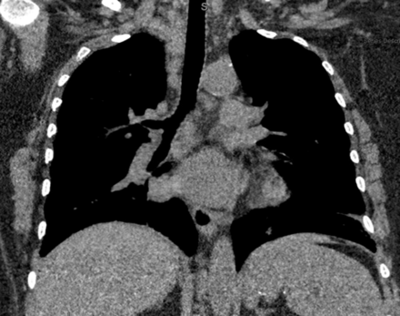 CT of the chest without contrast demonstrating mediastinal lymphadenopathy.