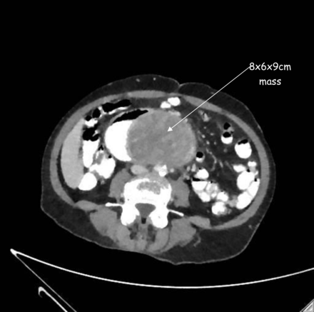Abdominal CT scan showing a duodenal mass (8×6×9 cm).
