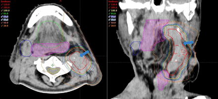 CT with dose distribution of radiotherapy with 25 Gy in five fractions. The light blue arrow indicates the carotid sinus. The yellow, magenta, green and blue contours indicate the spinal cord, reconstructed jejunum, oral cavity and submandibular grand, respectively.