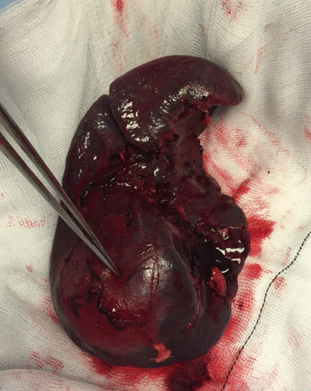 Specimen: spleen measuring 18×11×6 cm and weighted 444.6 g, revealing a 8×5.2×5.3 cm multinodular tumour.