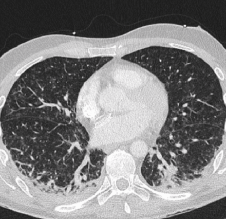 CT thorax showing bilateral consolidation.