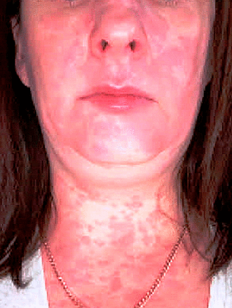 Urticarial erythematous eruption affecting the face, neck and upper chest. In addition, there is mild angioedema of the lower lip, as a result of excess interstitial fluid in the dermis and subcutaneous tissue.