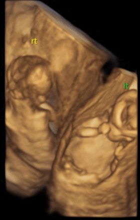 Three-dimensional ultrasound imaging of both fetuses in each uterine cavity, 12 weeks and 6 days gestation.