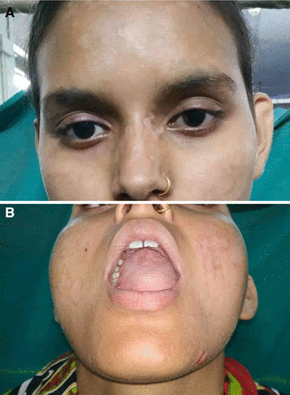 (A) Healed skin lesions after treatment, and (B) healed palatal and tongue ulceration following treatment.