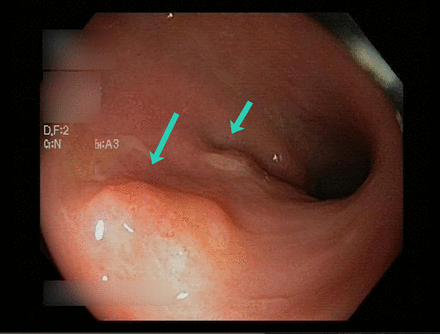 Endoscopic visualisation of the colonic wall. Note the decrease in haustration and submucosa nodularity (arrows).