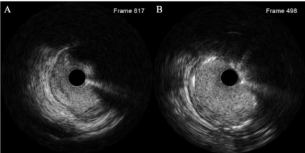 (A) Intravenous ultrasound system (IVUS) revealed a focal severe stenosis and narrowing external vessel diameter without significant intravascular plaque. (B) IVUS imaging following the stent implantation. The coronary stent was incompletely expanded at kinked segment, whereas significant malapposition was not confirmed.