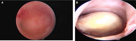 Hysteroscopy showing (A) empty uterine cavity (B) intramyometrial ectopic pregnancy within a false tract passing through the posterior uterine wall.