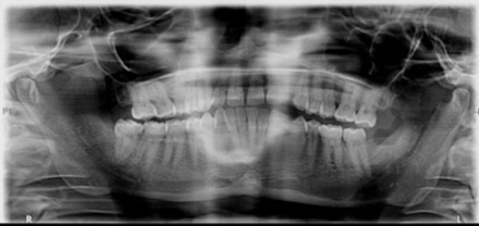 Orthopantomogram at 2-year follow-up showing absence of coronoid regeneration and the osteotomy defect at the left coronoid region.