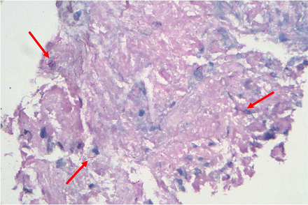 The Ziehl-Neelsen stain of the mycotic aneurysm biopsy. The stain shows numerous acid-fast bacilli within the necrotic debris (arrows).