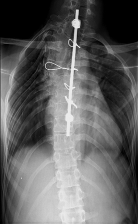 Anteroposterior radiograph at final follow-up after scoliosis surgery.