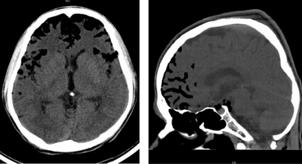 Day 3: multiple air pockets are in bilateral frontal and temporal subarachnoid spaces.