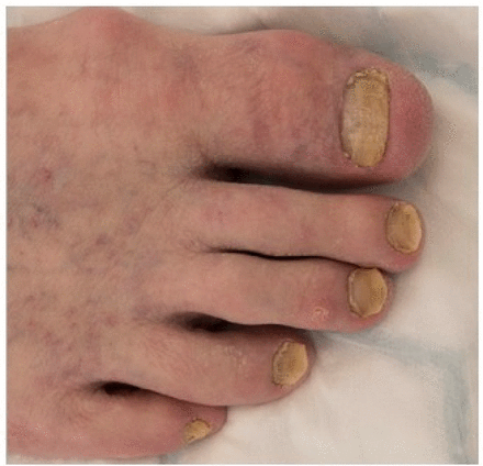 Scleronychia. Image showing thickened nail folds with yellowish discolouration of the nails suggestive of yellow nail syndrome.