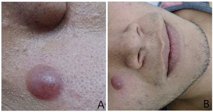 Clinical presentation. Dermatosis localised in the right infraorbital region, there is a violeterythematous nodule of 1.5 cm of diameter approximately, in the shape of a dome, with defined edges, with telangiectasias, firm and asymptomatic (A). Right infraorbital region lesion prior to the surgical resection (B).