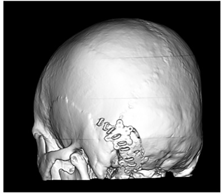 Three-dimensional reconstruction of CT images after biopsy demonstrating lateral suboccipital craniotomy.