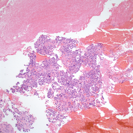 Endometrial biopsy pathology. High-grade trophoblastic neoplasm in a background of abundant blood and fibrin (H&E, ×100).