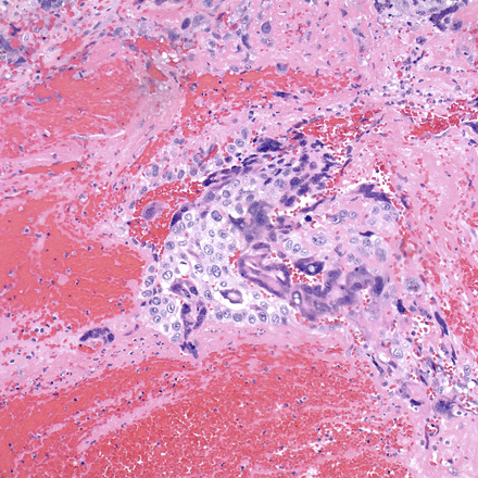 Hysterectomy specimen pathology. Trimorphic population of syncytiotrophoblasts, cytotrophoblasts and intermediate trophoblasts, characteristic of choriocarcinoma (H&E, ×200).