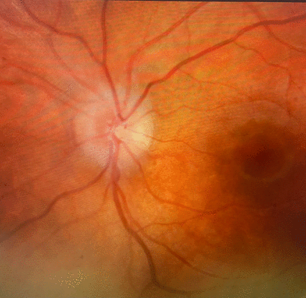 Left eye funduscopic appearance demonstrating papilloedema.