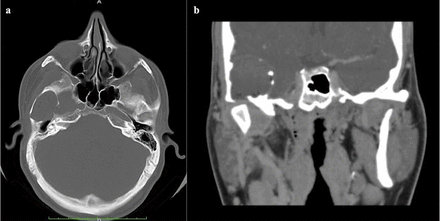 Preoperatice CT-scan, axial (A) and coronal (B) planes showing erosion of the temporal bone and of the middle fossa plate with involvement of the glenoid fossa.
