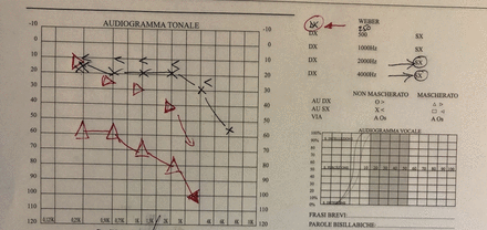 Preoperative pure tone audiometry showing a severe mixed hearing loss with a downward curve in the high frequencies. Dx: right; AU: ear; SX: left; VIA: conduction.