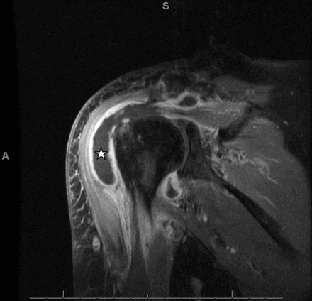 Post-contrast coronal T1-weighted MRI of the left shoulder with fat suppression and fast-spin echo demonstrating large glenohumeral joint effusion (star) with moderate synovitis and thickened synovial enhancement.