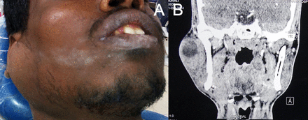 (A) Preoperative view. (B) CT scan with contrast.