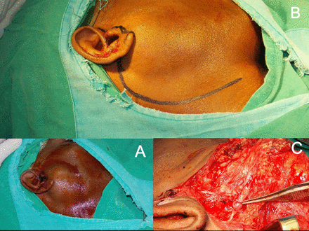 (A) Patient draped and prepared. (B) Incision marked. (C) Intraoperative view.