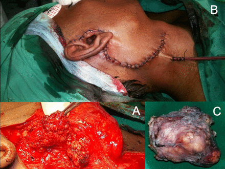 (A) Intraoperative view. (B) Postoperative figure showing the drain in place. (C) Specimen.