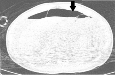 Abdominal CT for pneumoperitoneum assessment, enhanced by the use of lung window (black arrow).