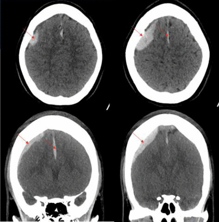 Head and spine CT. Right extra-axial acute haemorrhage and a possible small left acute subdural haemorrhage are evident.