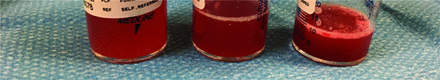 Progressive serial increase in red discolouration of bronchoalveolar lavage fluid suggestive of active alveolar haemorrhage. A bronchial source would show rather clearing up of bloody discolouration as the tip of the bronchoscope would be sealed off from the airway during bronchoalveolar lavage.