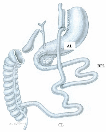 Schematic illustration of Roux-en-Y gastric bypass. AL, alimentary limb; BPL, biliopancreatic limb; CL, common limb.