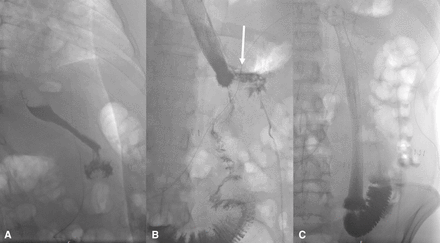 (A) Barium contrast X-ray. A: Roux-en-Y gastric bypass postoperative day 1. (B) Passage of contrast agent over the fistula to the gastric remnant (arrow). (C) Bridged fistula and anastomosis with 23 cm metal stent.