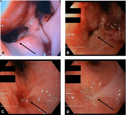 Endoscopic view of the gastrogastric fistula (arrows). (A) Intraoperative endoscopy, (B) after 10 days, (C) after 6 weeks (D) after 10 weeks of stent treatment.
