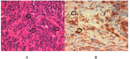 (A) Important lymphocitary infiltrated that is suggested lymphoepithelial carcinoma. (B) Important CD4 infiltrated.