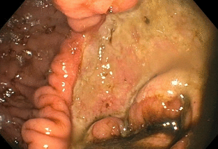 Large ulcer noted in the antrum along the greater curvature.