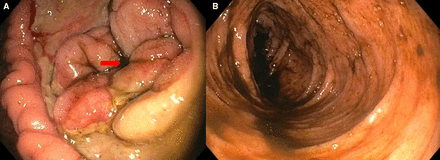 Gastrocolic fistula identified within the ulcer as denoted by arrow (A) followed by colonic intubation and traversal (B).