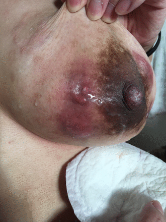Draining fistula of the lateral breast postpartum.