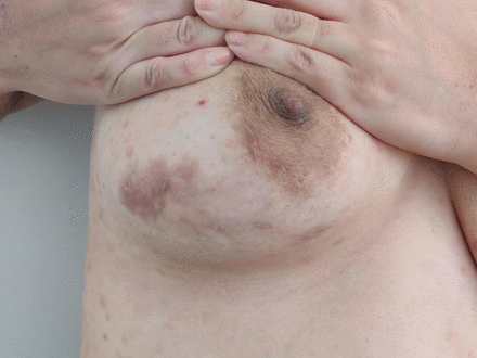 Residual scar on the lateral aspect of the left breast 4 years after the diagnosis and management of idiopathic granulomatous mastitis.