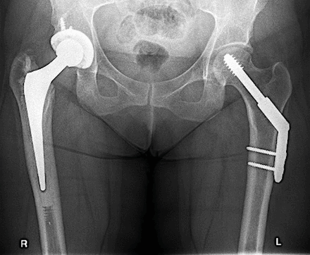 Postoperative anteroposterior X-ray of right total hip replacement (THR) and left dynamic hip screw (DHS).