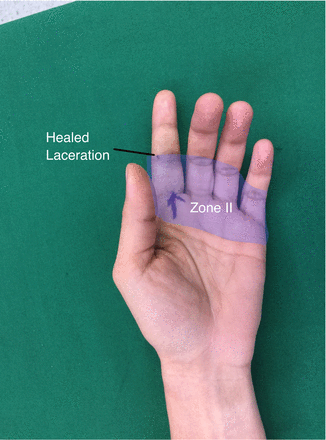 In patient 2, the IF was in an extended position compared with the other fingers. The healed laceration (black line) is seen within the zone II of the hand (shaded area). IF, index finger.