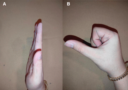 (A,B) Patient 1 at 36 months follow-up with very good range of motion of the right IF. IF, index finger.